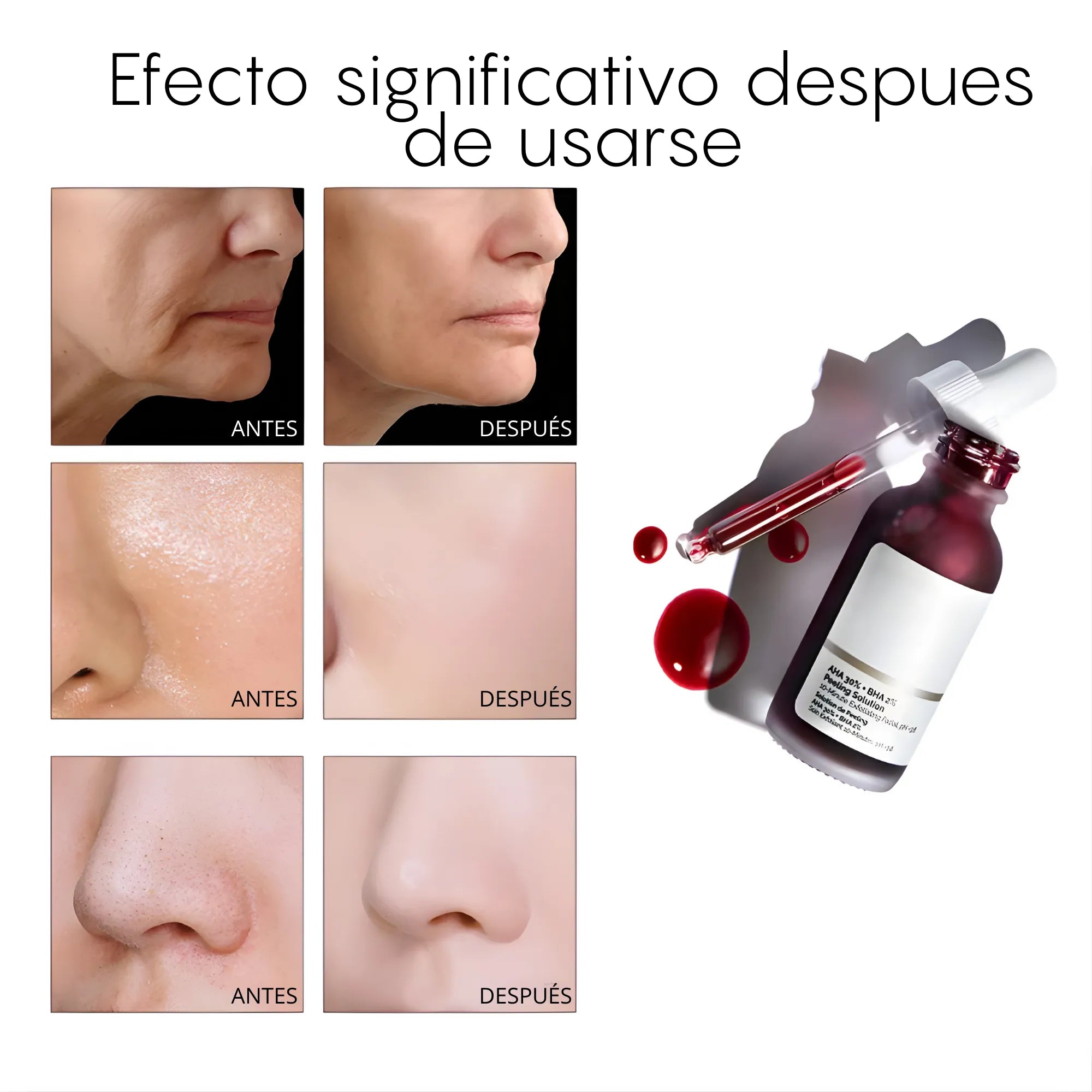 Suero Exfoliante Peeling Facial AHA 30% + BHA 2% | Solución Renovadora de 10 Minutos para Manchas, Acné y Poros | Con Aloe Vera y B5