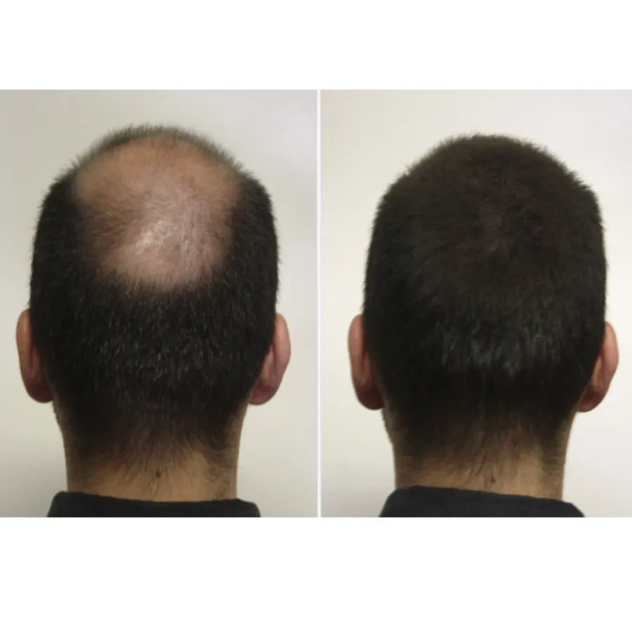 Fibras Capilares Dexe 22g | Maquillaje Capilar para Calvicie y Cabello Fino | Resultado Natural e Instantáneo | Resistente al Agua y Viento